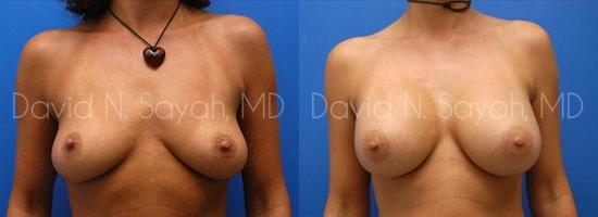 Breast Augmentation Before and After | Sayah Institute