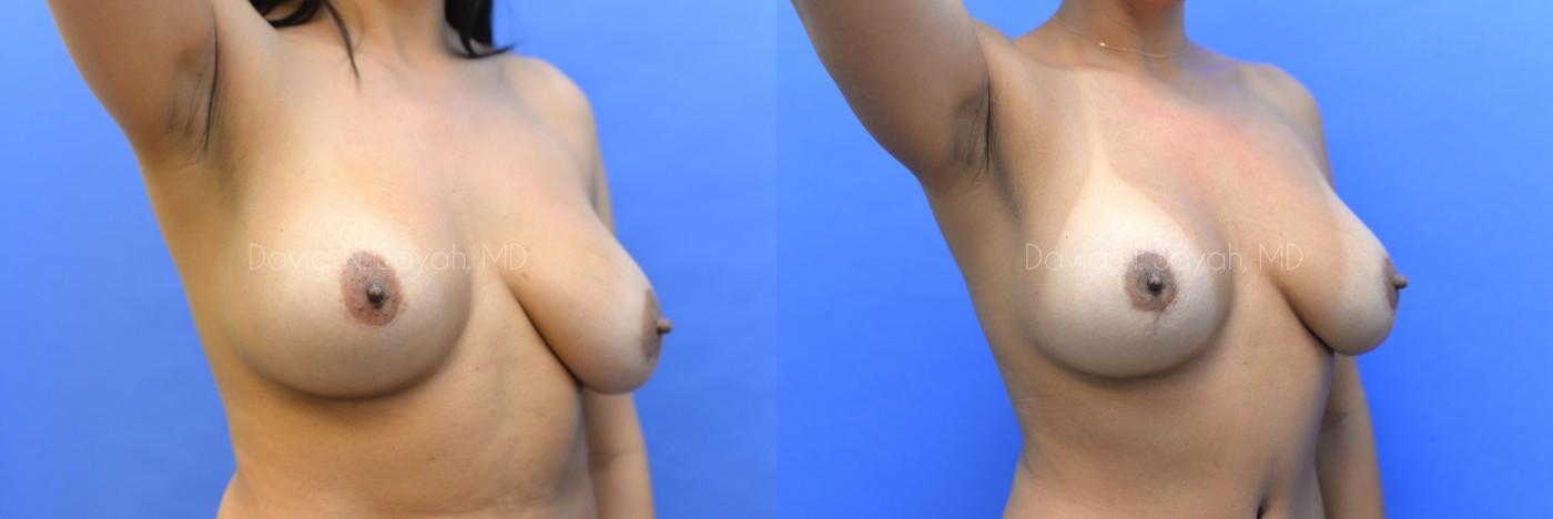 Breast Lift Before and After | Sayah Institute