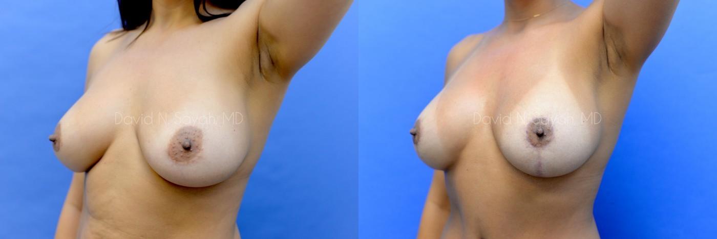 Breast Lift Before and After | Sayah Institute