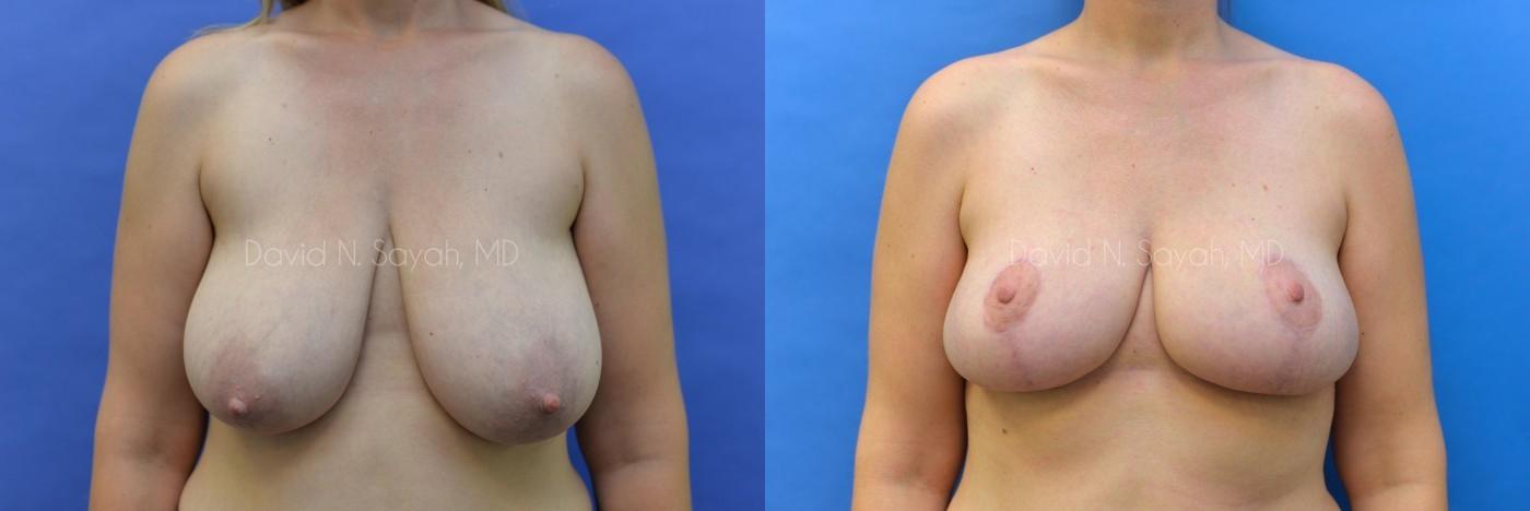 Breast Lift Before and After | Sayah Institute
