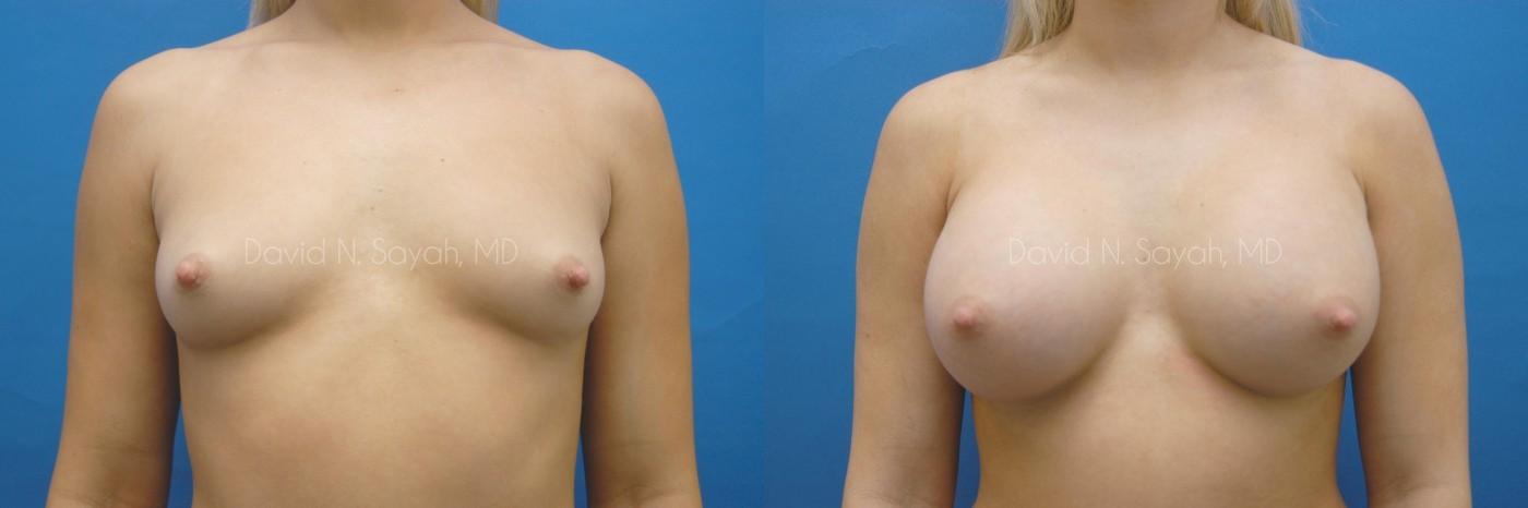 Breast Augmentation Before and After | Sayah Institute