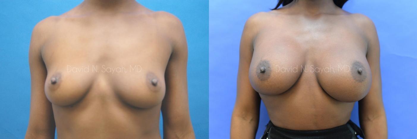 Breast Augmentation Before and After | Sayah Institute