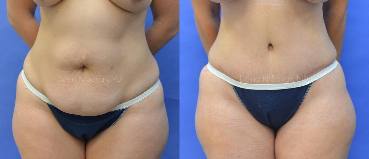 Liposuction Before and After | Sayah Institute