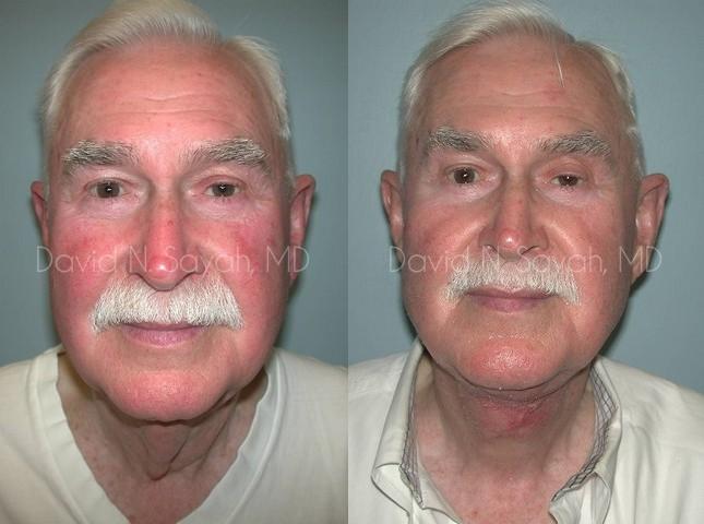 Neck Lift Before and After | Sayah Institute