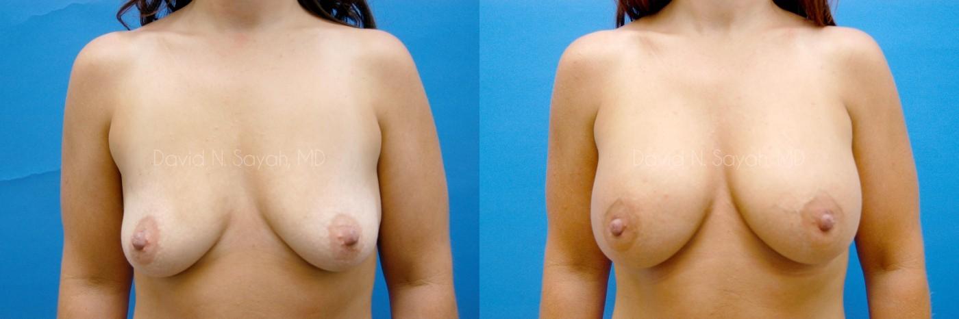 Breast Augmentation Before and After | Sayah Institute