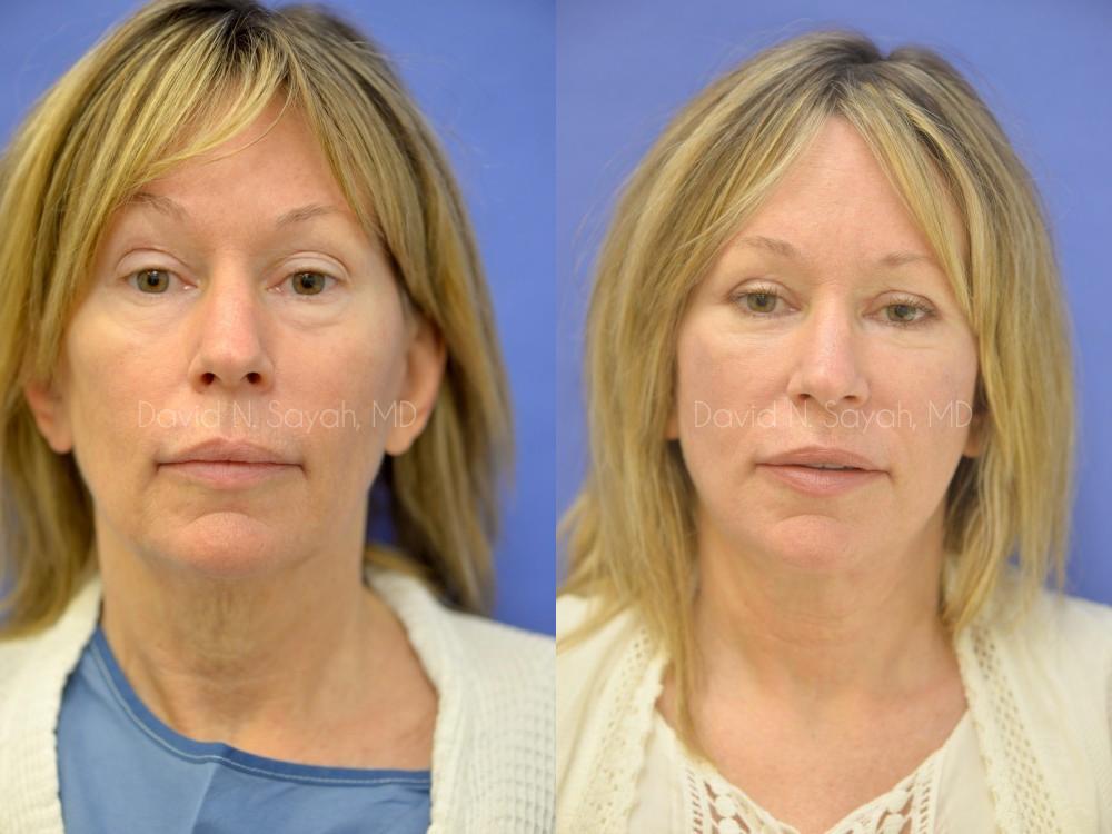 Facelift Before and After | Sayah Institute