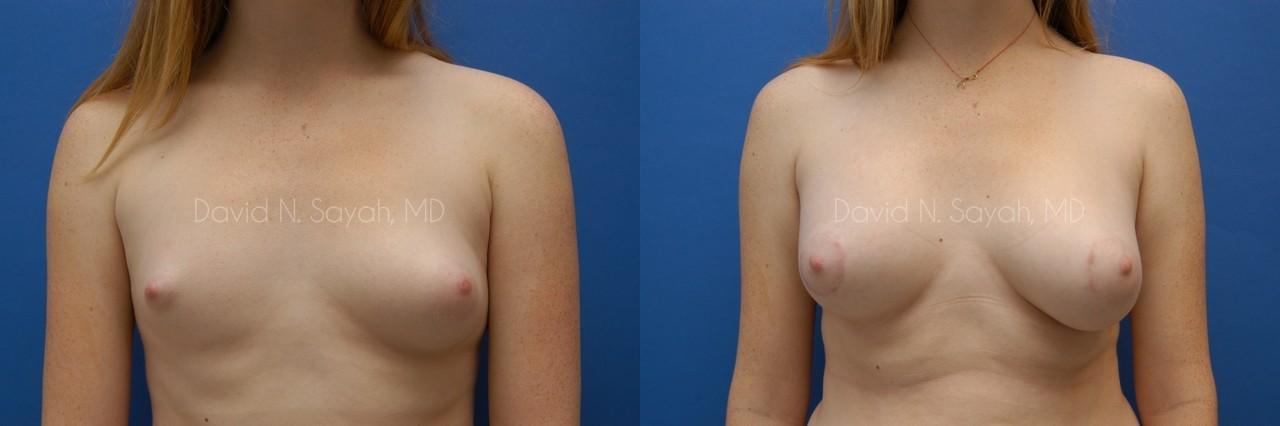 Breast Augmentation Before and After | Sayah Institute