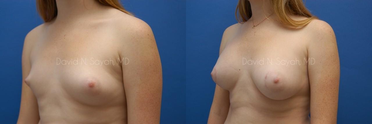 Breast Augmentation Before and After | Sayah Institute