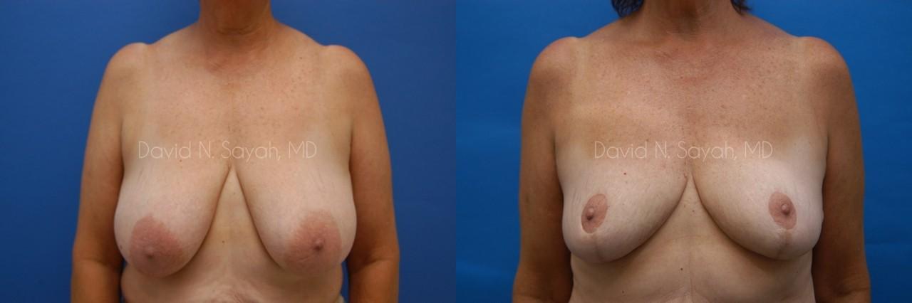 Breast Reduction Before and After | Sayah Institute