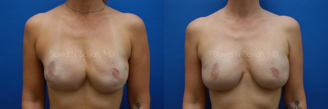 Breast Reconstruction Before and After | Sayah Institute