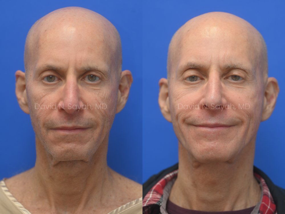 Side-by-side photos of a bald man before and after a medical or cosmetic procedure, with slight differences in facial appearance and expression.