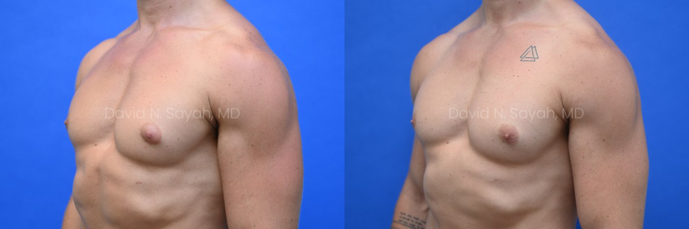Side-by-side side-view comparison of a male chest before and after gynecomastia surgery, with the left image showing excess breast tissue and the right image showing a flatter, more contoured chest profile.