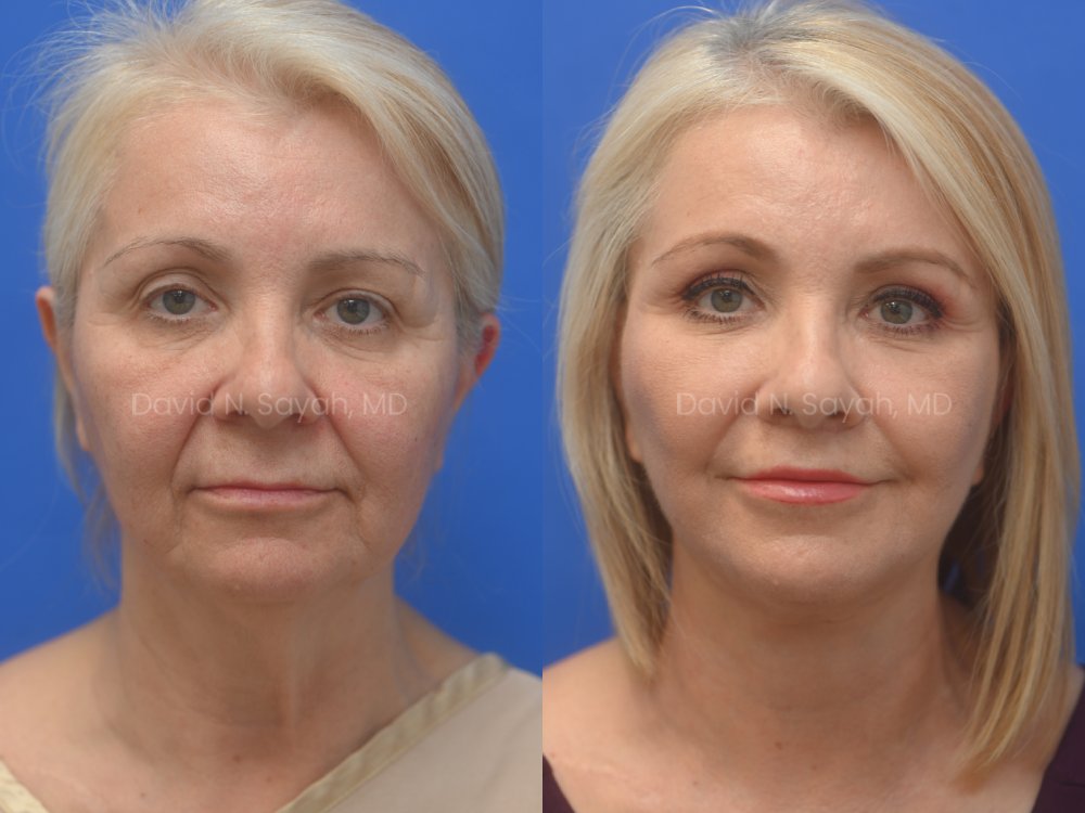 Facelift, Neck Lift, Fat Graph Lips and Face Before and After | Sayah Institute, front view
