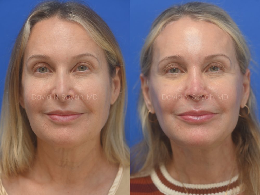 Facelift, Neck Lift, Lip Fat Grafting, Revison Rhinoplasty, Co2 laser Before ans After | Sayah Institute, front view